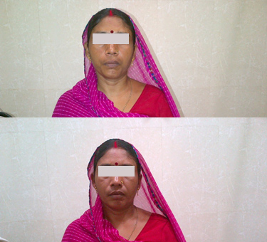 Case Of Facial Palsy. Before and after Treatment